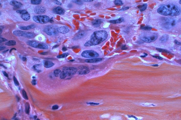 Ученые обнаружили схожесть между раковыми клетками и пивными дрожжами в части их способности впадать в спячку